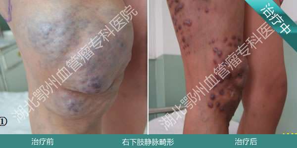 鄂州中医血管瘤专科医院 康复案例  右下肢静脉畸形 患者:李某 性别