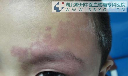 前额鲜红斑痣图片解读