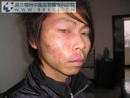 成人面部鲜红斑痣图片_鄂州中医血管瘤专科医院