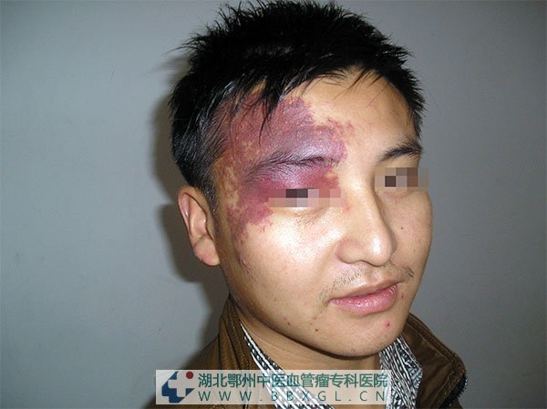 面部鲜红斑痣图片危害解读_鄂州中医血管瘤专科医院