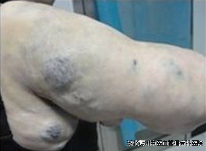血管瘤大多数是生长在皮下组织内的,并且常常会侵入到深部的 肌肉组织