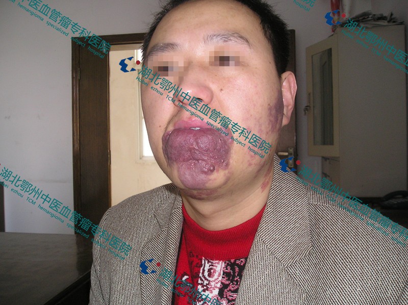 口腔颌面部血管瘤应该怎样治疗?