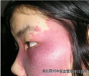 鲜红斑痣