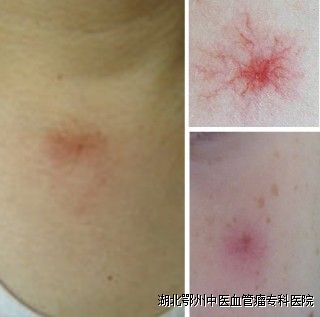 蜘蛛痣(spider angioma)是由一支中央小动脉及许多向外放散的细小血管