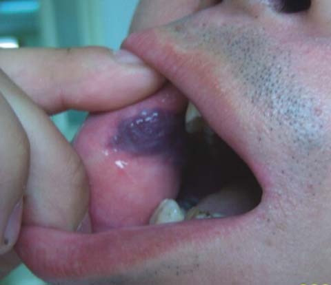 舌部血管瘤怎么办?